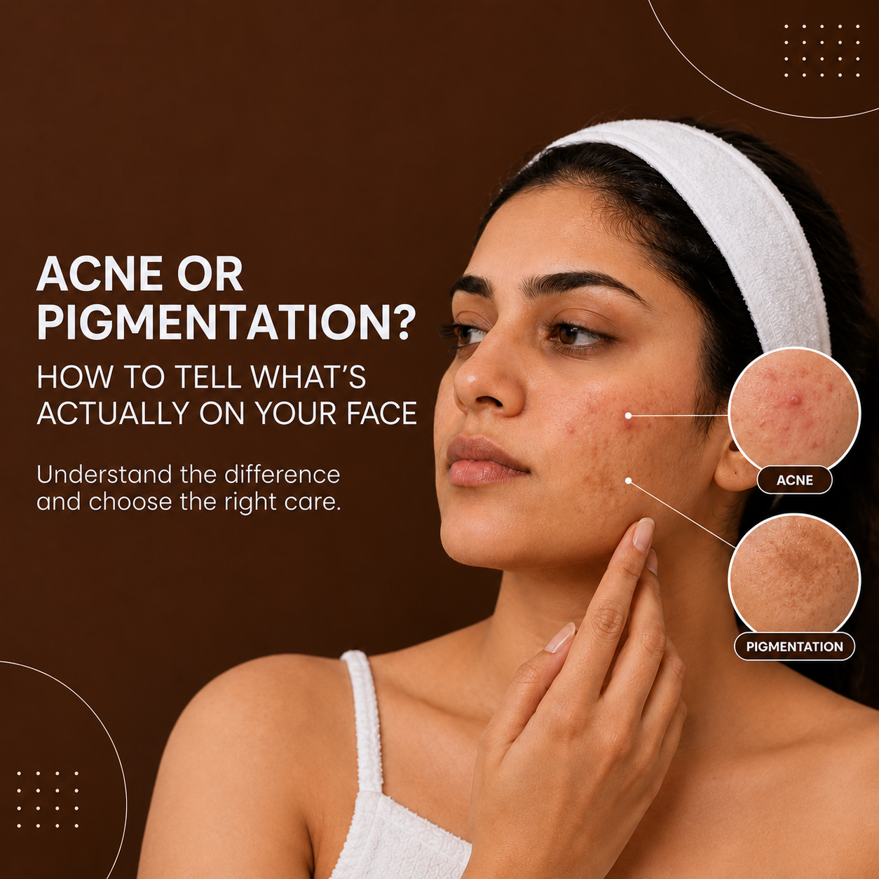 Acne & Pigmentation Treatment